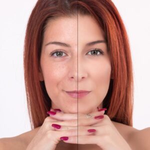 20% Off Skin Irregularities Removal