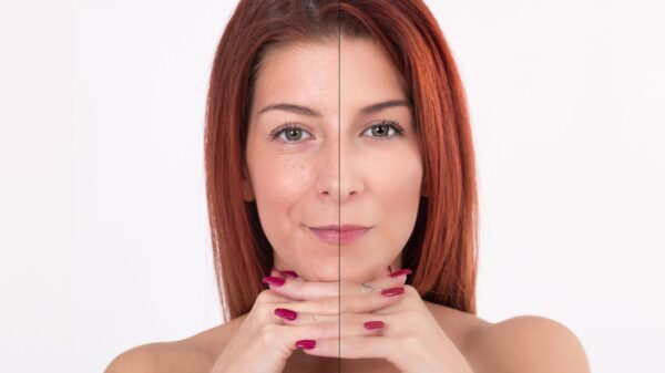 20% Off Skin Irregularities Removal