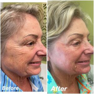 Plasma Skin Tightening 20% Off